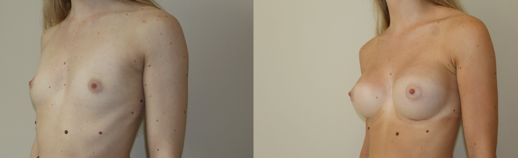 Avant/Après prothèses mammaires